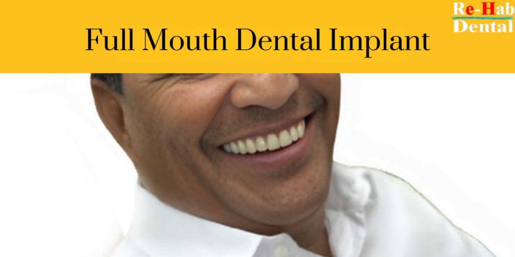 Understanding Full Mouth Dental Implant Costs