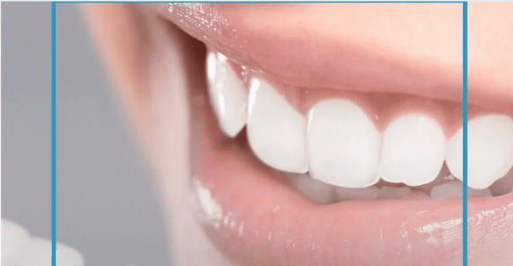 Five Essential Facts About Teeth Whitening You Should Know